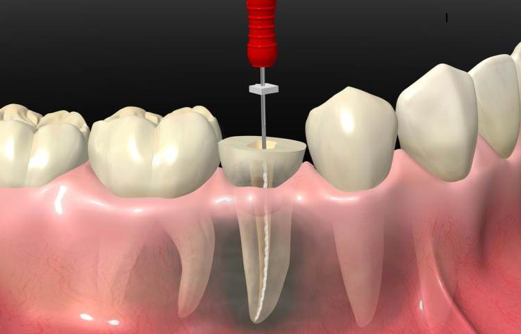 Root canal treatment: Saving Tooth!