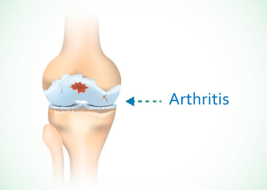 TheJointStory: Increased pain during winters
