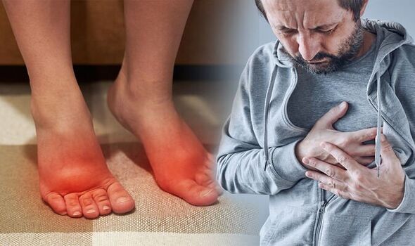 Swelling in legs, ankles or abdomen may be sign of heart failure: Expert